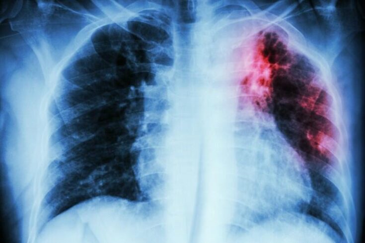 an X-ray of lungs with pulmonary tb