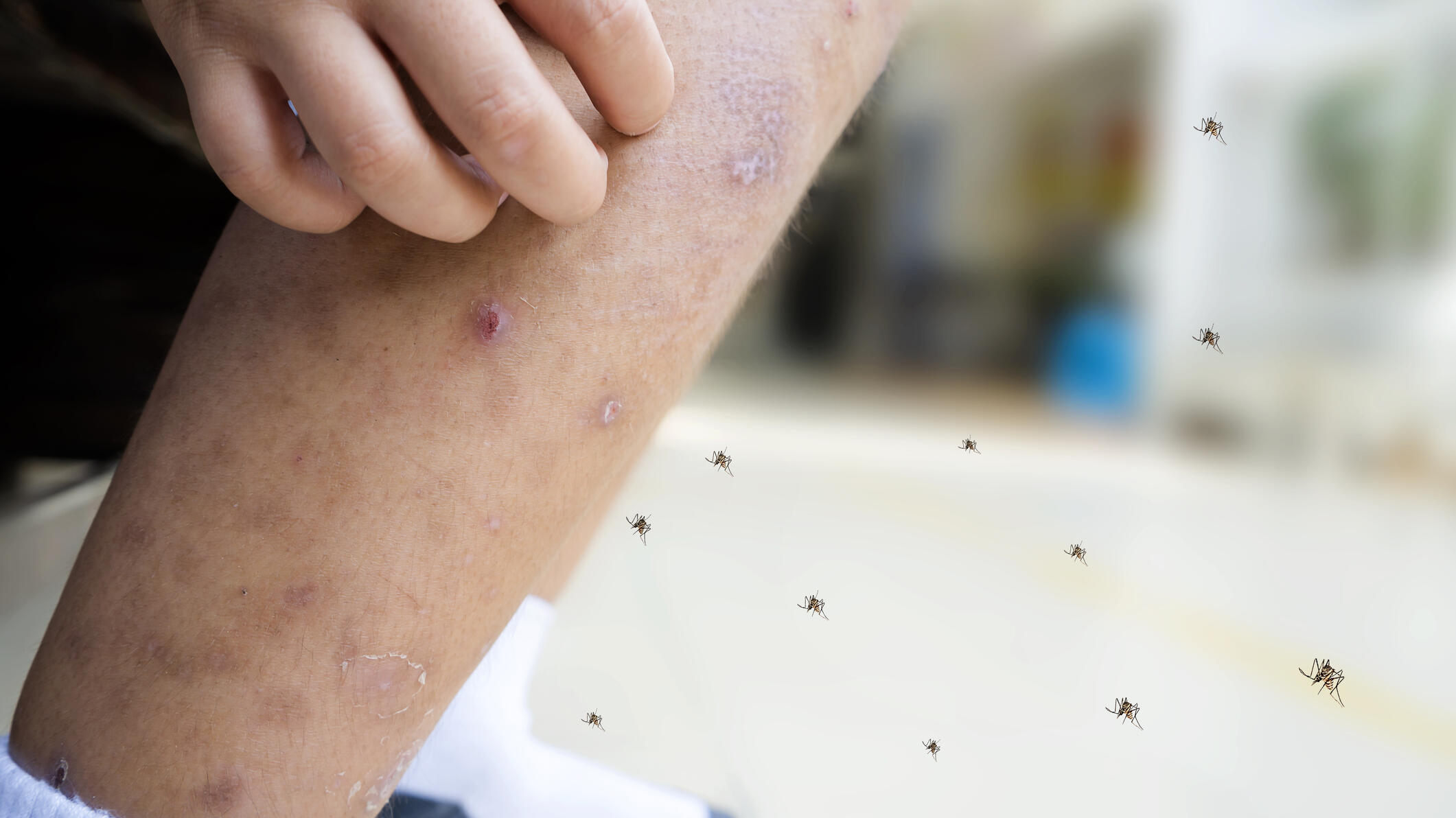 A photo of a leg covered in mosquito bites with a hand scratching them. There are many mosquites in the air near the leg.