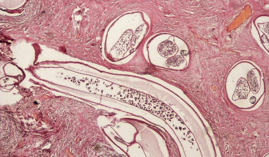 Microscopic image of Onchocerca volvulus parasites in a tissue section. The cross-section shows multiple roundworm larvae encased within fibrous tissue, stained pink and purple, characteristic of the parasitic infection causing river blindness.