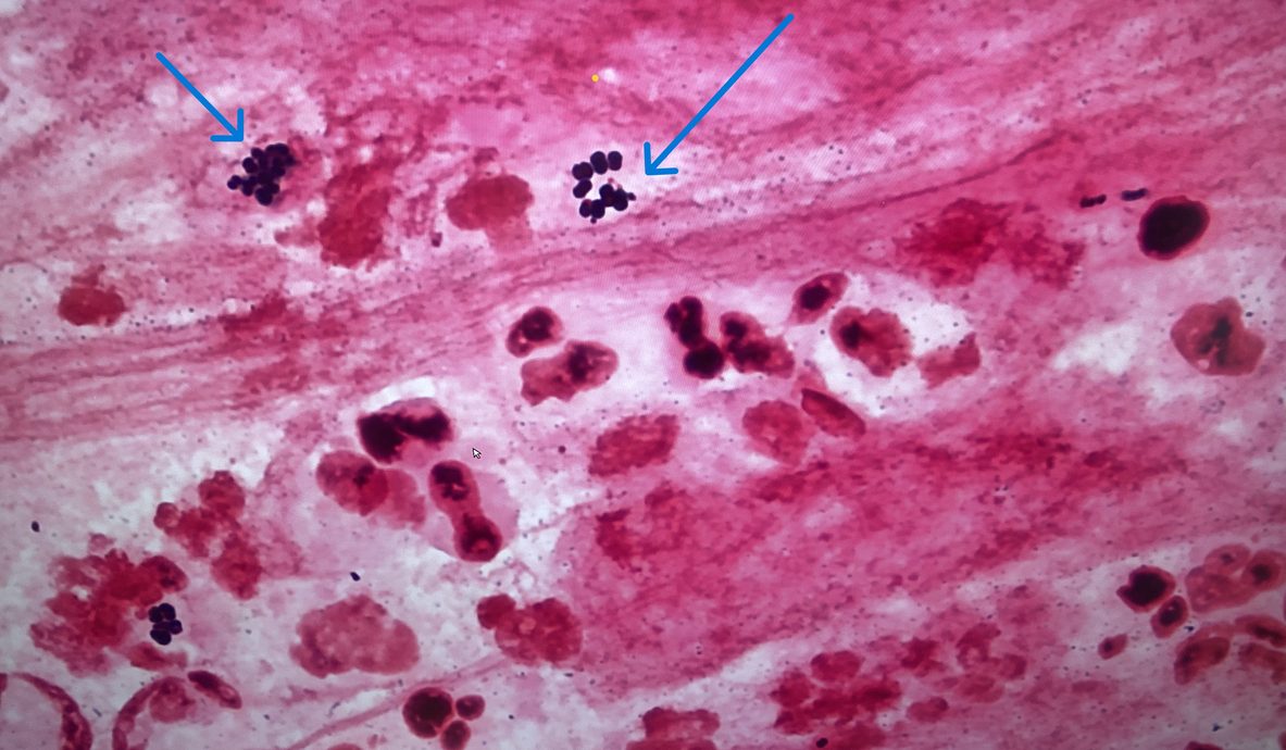 The blue arrows show the position of Gram-positive cocci in clusters. Clinical diagnostic sputum tests can detect the causes of lower respiratory tract infections. Sputum is mucus that is coughed up from the lower airways.