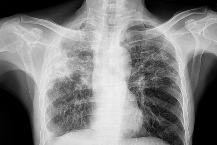 Chest xray of the patient with lungs tuberculosis showing reticulonodular opacity involve both lungs from granulomatous TB infection.